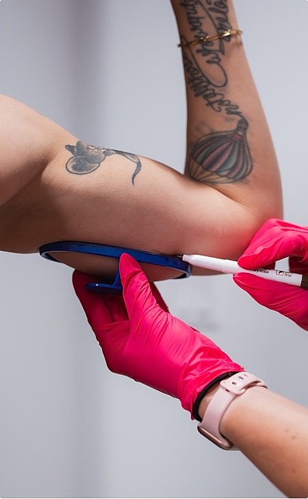 Healthcare professional marking a patient's arm.