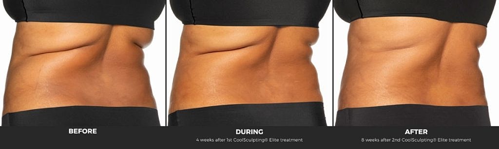 CoolSculpting results: before, during, and after.