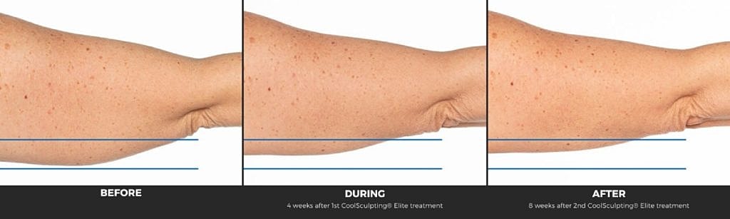 CoolSculpting treatment results: before, during, after.