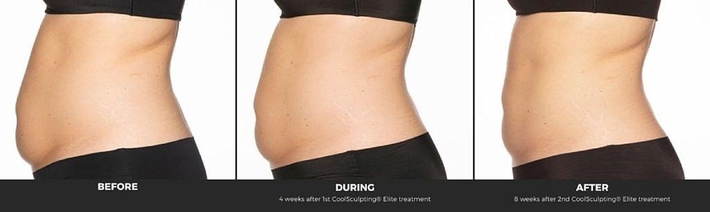 CoolSculpting treatment progress: before, during, after.