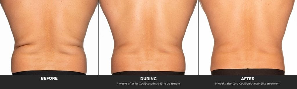 CoolSculpting results: before, during, and after treatment.