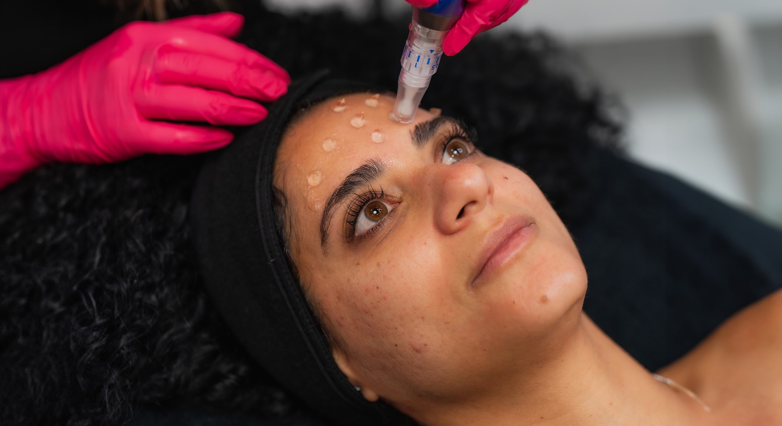 Microneedling treatment on a woman's forehead.